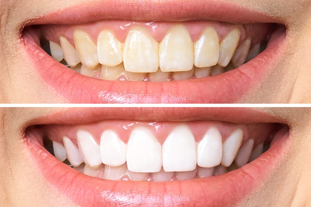 Teeth whitening before and after comparison